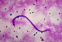 [ Photomicrograph of microfilaria ]