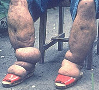 [ Swelling caused by filariasis ]