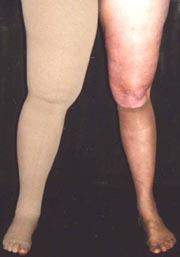 Lymphedema Garments